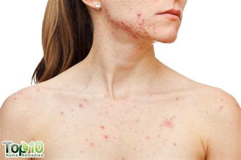 How To Treat Hormonal Acne Top 10 Home Remedies