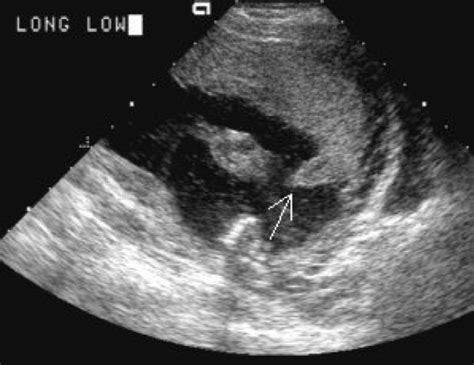 Recognizing Intra Amniotic Band Like Structures On Obstetric Ultrasound