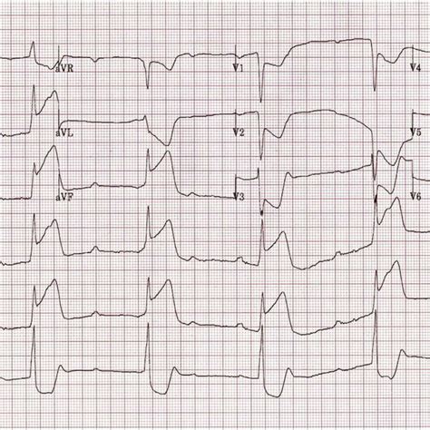 Electrocardiogram Showing Inferior Wall St Segment Elevation Myocardial