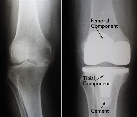 Total Knee Replacement Orthoinfo Aaos