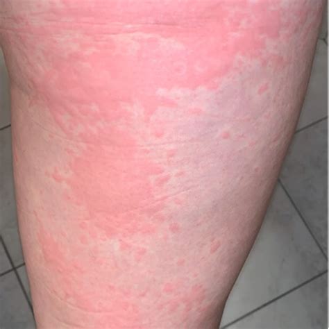 Cutaneous Manifestations Associated With Covid 19