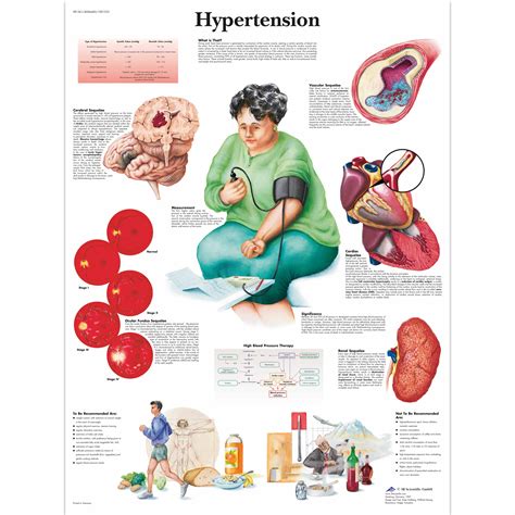 The Anatomy Of Hypertension Chart Poster Laminated Mx