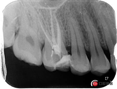 几例后牙根管治疗的病例分享 吴蓉的博客 Kq88口腔博客
