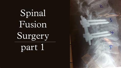 Spinal Fusion Surgery Pt1 Youtube