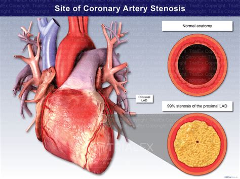 Site Of Coronary Artery Stenosis Trialexhibits Inc
