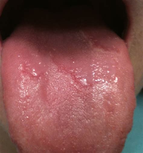 Penile Pearly Lesions Wiki What Do Large Bumps On Back Of Tongue Mean