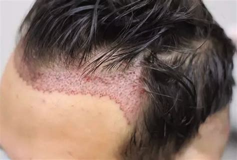 Greffe de cheveux DHI Turquie : Prix implant capillaire DHI - Medespoir
