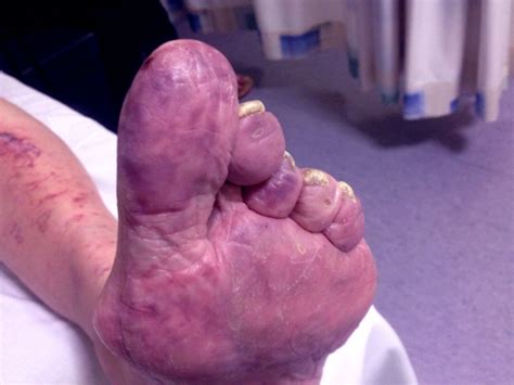Warfarin Induced Purple Toe Syndrome Successfully Treated With Apixaban
