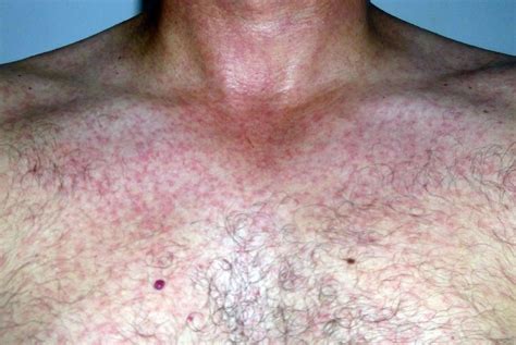 Maculopapular Rash Pictures Causes Treatment Definiti