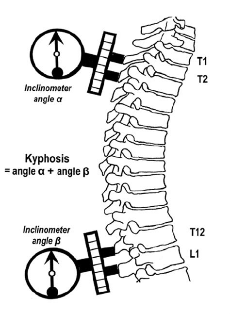 Thoracic Kyphosis Angle Calculated By The Summation Of The Inclinometer Download Scientific