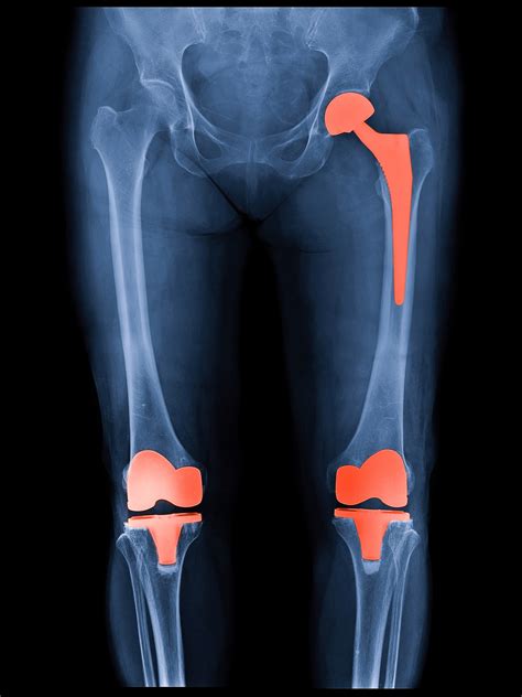 Hip Replacement Surgery Why You May Experience Thigh And Knee Pain