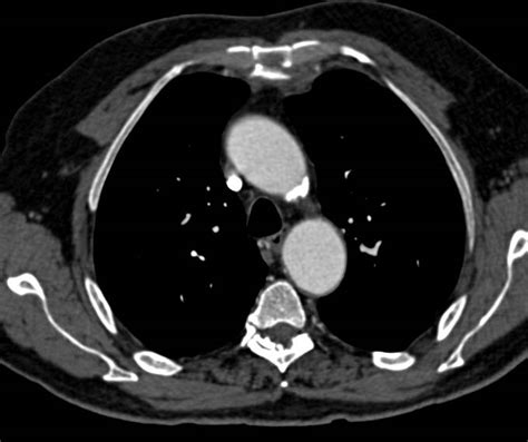 Sternal Fracture With Retrosternal Hematoma Trauma Case Studies