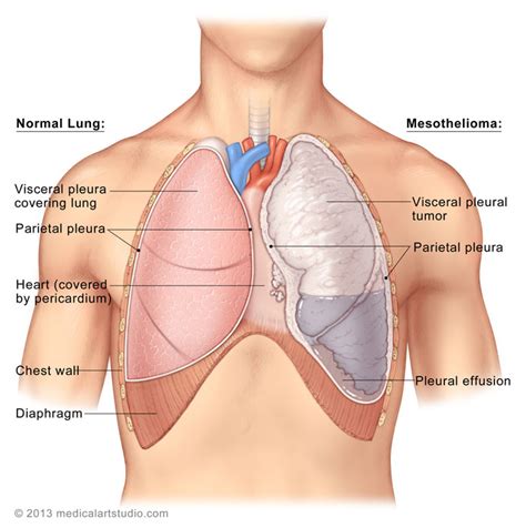 Diagnosing pleural mesothelioma because its symptoms are nonspecific, meaning the symptoms also appear in many other conditions, pleural mesothelioma can be difficult to diagnose. Appellate Court Affirms Increase in Pain and Suffering ...