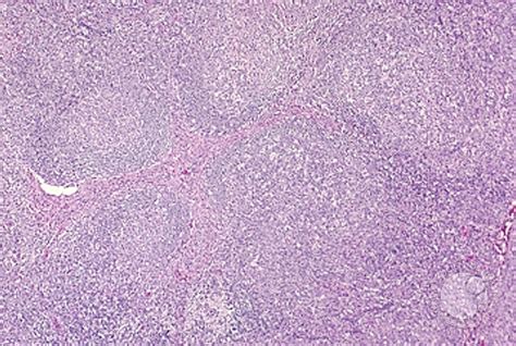 It is characterized by a unique clinical presentation and distinct pathologic and molecular features. Angioimmunoblastic T Cell Lymphoma - 3.
