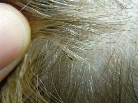 How To Identify Lice And Nits Lice Eggs