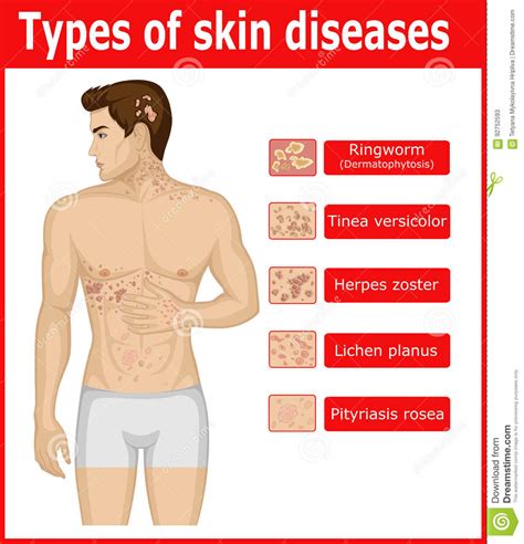 Types Of Skin Diseases Stock Vector Illustration Of Herpes 92752593