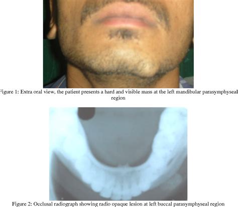 Figure 2 From Peripheral Osteoma Of Mandible Semantic Scholar