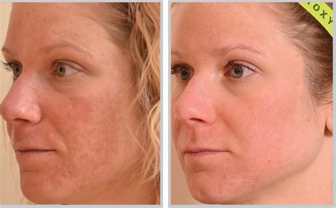 Atlanta Cosmetic Surgery Skin Treatments Dr Burke Robinson