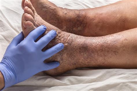 6 Tipos De Eczema Síntomas Y Causas 2023