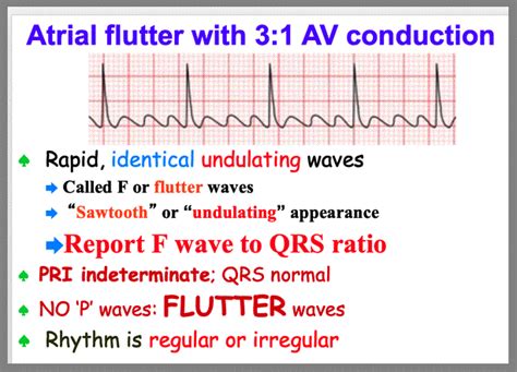 Atrial Flutter And Atrial Fibrillation