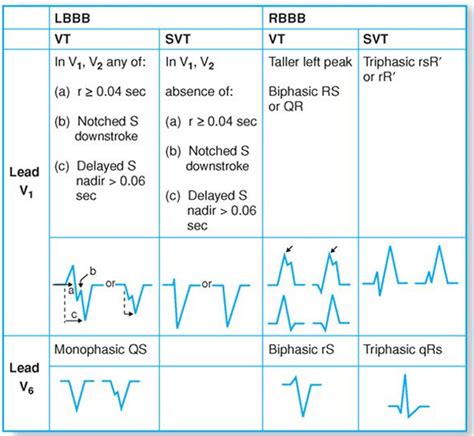 Brugada Algorithm To Differentiate Vt From Svt With Aberrant Conduction