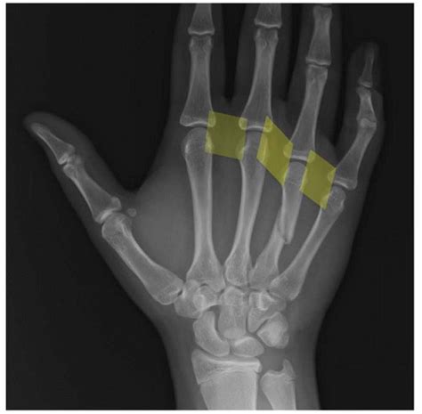 Metacarpal Metacarpal Fracture Treatment In Raleigh Durham Cary Nc