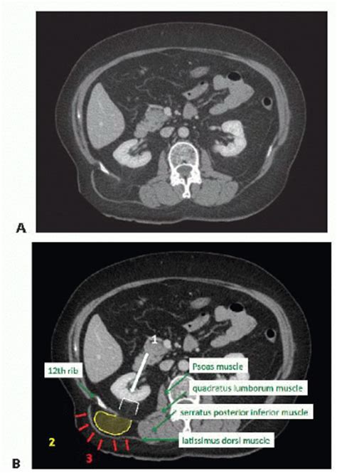 Umbilical Epigastric Spigelian And Lumbar Hernias Basicmedical Key