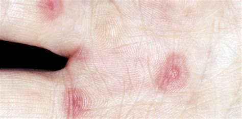 In Pediatric Erythema Multiforme Minor Is Herpes A Common