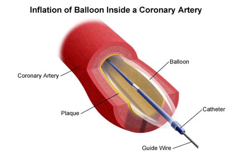Cardiac Catheterization And Cardiac Intervention