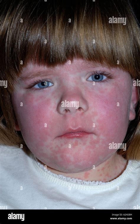Amoxicillin Drug Rash On Young Girl Stock Photo Alamy