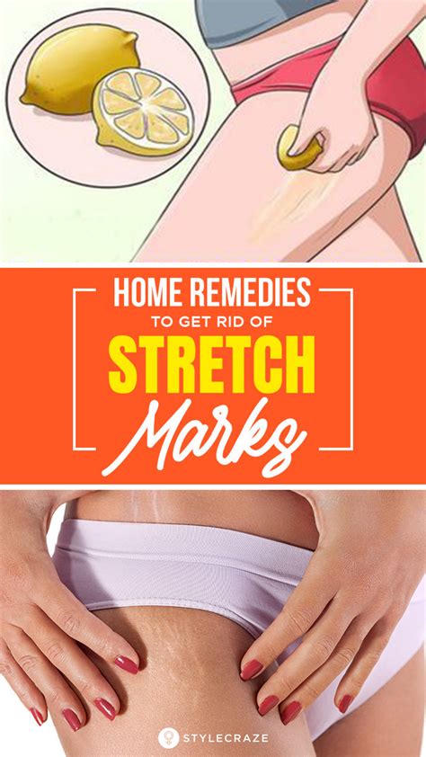Strech Marks Remedies Strech Marks Removal Stretch Marks On Thighs