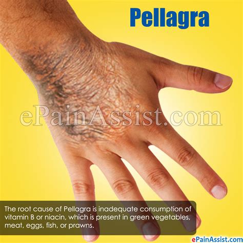 Is Pellagra An Autoimmune Disease Captions Tempo