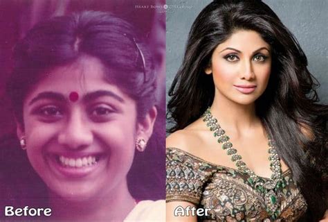 Indian Celebrities Before And After Plastic Surgery Famousfaceshub