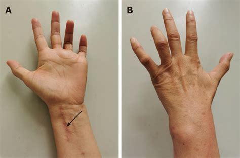 Ulnar Nerve Entrapment Wrist