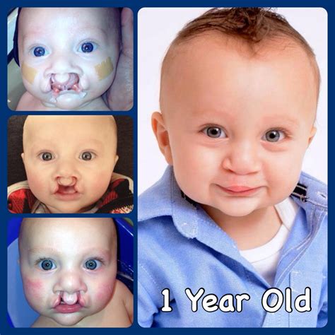 Albums 99 Pictures Cleft Palate Before And After Pictures Completed 10