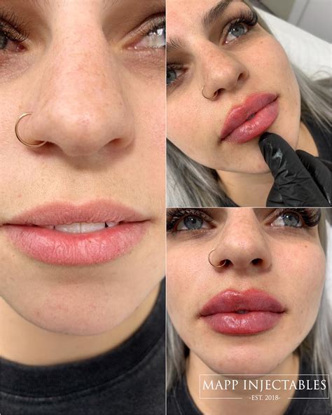 Difference Between 1ml Of Thin Med And Thick Lip Filler