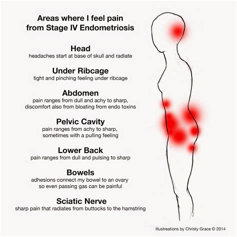 Symptoms Endometriosis