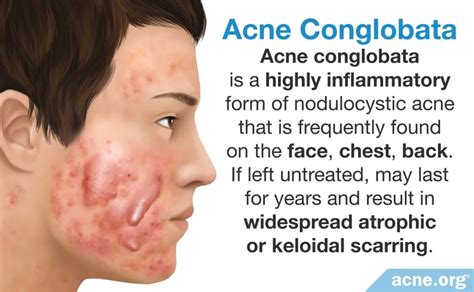 What Is Cystic Acne Acne Org