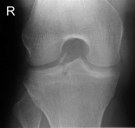Supine Intercondylar Knee Radiography Wikiradiography