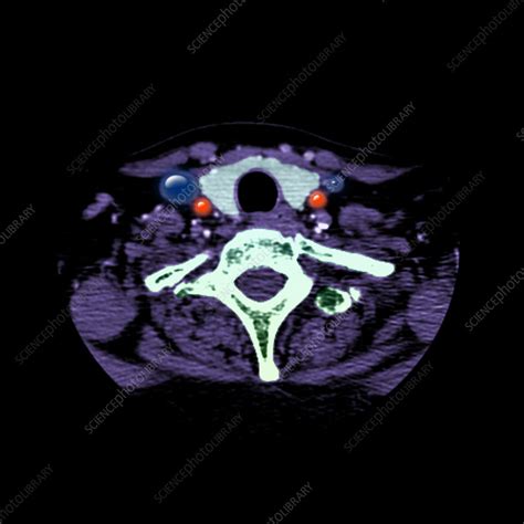 Ct Of Neck And Normal Thyroid Gland Stock Image P7500153 Science