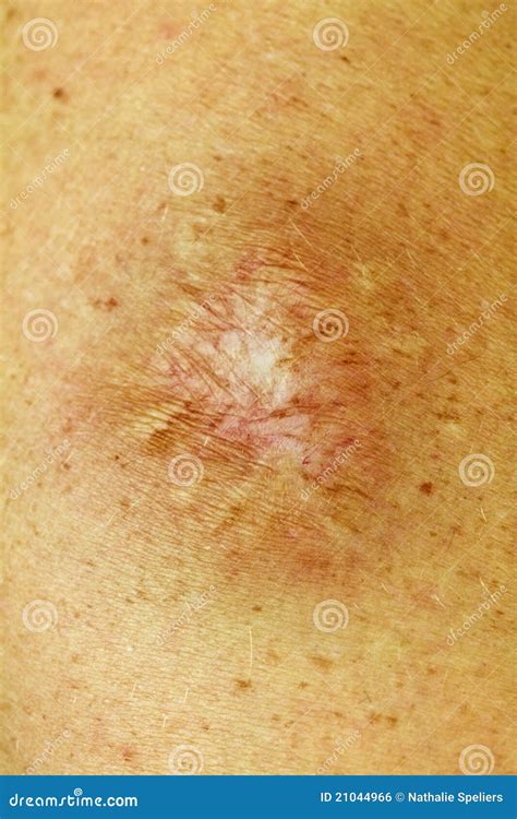 Dog Bite Scar Stock Photo Image Of Stitches Wound Medicine 21044966