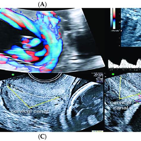 Second Trimester Transvaginal Scan And Three Dimensional Ultrasound