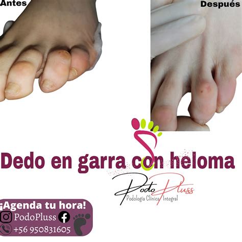 Dedo En Garra Con Heloma Dorsal En La Podopluss Temuco Facebook