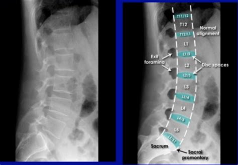 A Review On Reading Lumbar X Rays Sports Medicine Review