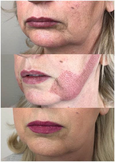 Fibroblast Skin Treatment Before And After Your Magazine Lite