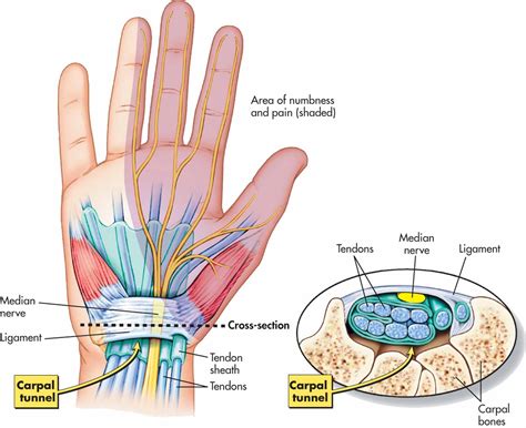 Carpal Tunnel Syndrome Osteohealth