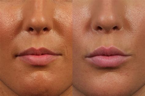 Avoid Lip Filler Mistakes Dr Brett Kotlus Cosmetic Oculoplastic Surgeon Nyc
