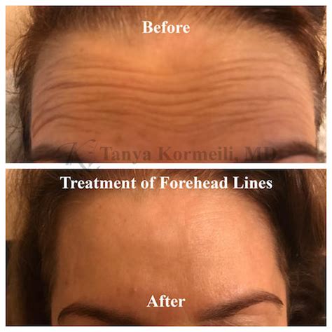 Best Forehead Lines Treatment Los Angeles And Santa Monica Dr Tanya
