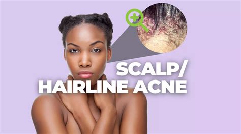 Top 5 Tips To Treat Scalphairline Acne Aqneeq
