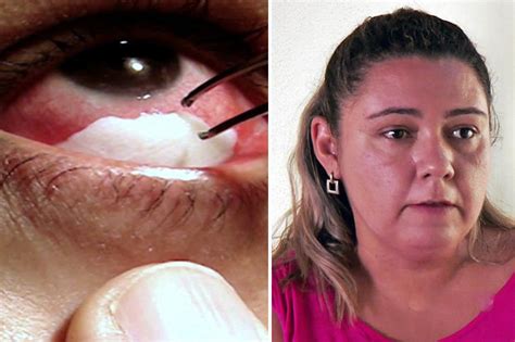 Woman Who Cries Crystal Tears Pulls 30 Membranes Out Every Day Daily Star